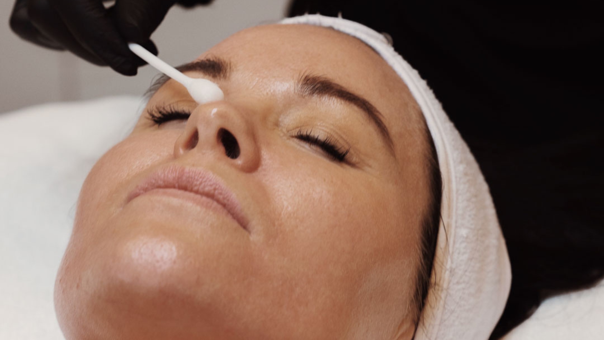 TCA peel | Kemisk peeling | Citylaser i Göteborg