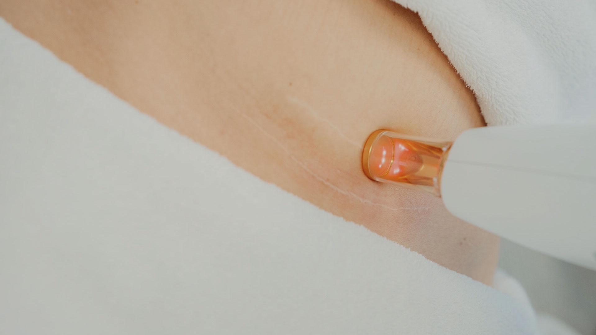 ärrbehandling med hjälp av laser