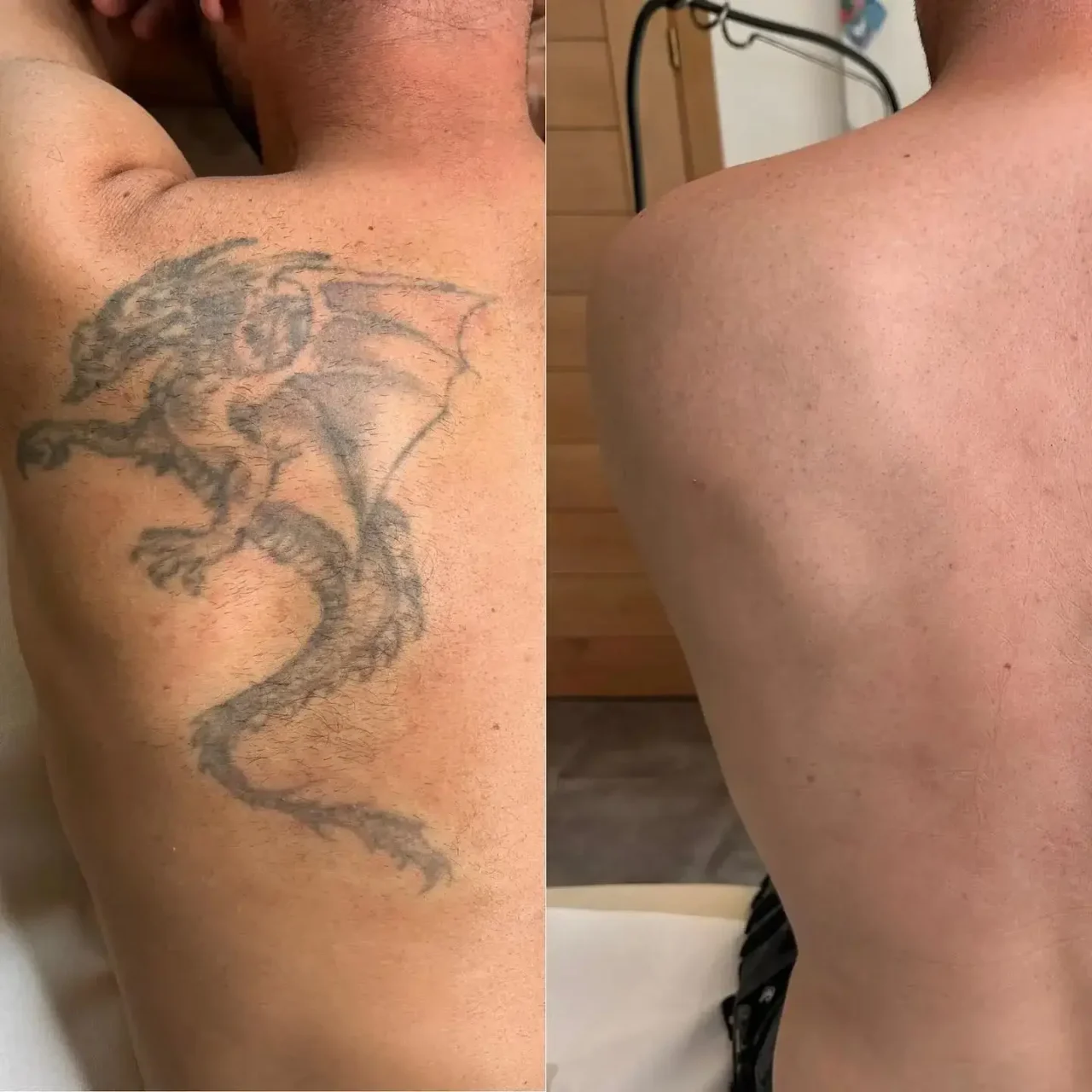 Borttagning av tatuering drake som visar före och efter behandling hos Citylaser i Göteborg